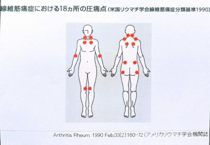 線維筋痛症における18カ所の圧痛点